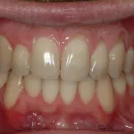 Before photo: Gum recession and exposed tooth roots in upper and lower jaws