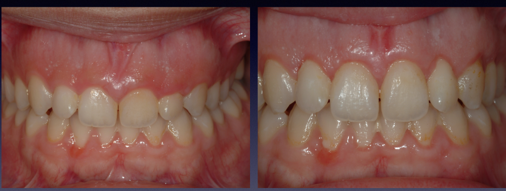 Before and After photos: Esthetic Crown lengthening