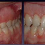 Before and After photos: Esthetic Crown lengthening