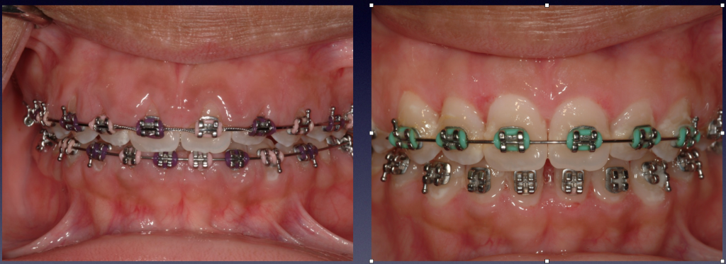 Before and After Photos: Upper and lower teeth crown lengthening to correct a gummy smile