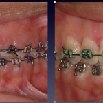 Before and After Photos: Upper and lower teeth crown lengthening to correct a gummy smile