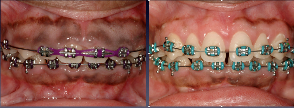Before and After Photos: Aesthetic crown lengthening to correct a gummy smile