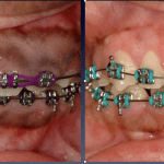 Before and After Photos: Aesthetic crown lengthening to correct a gummy smile