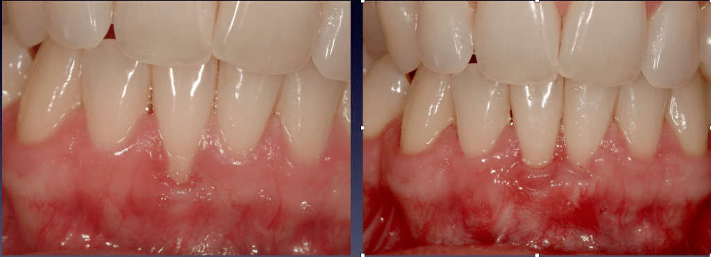 Before and After Photos: Gum Graft that covers exposed, sensitive tooth root