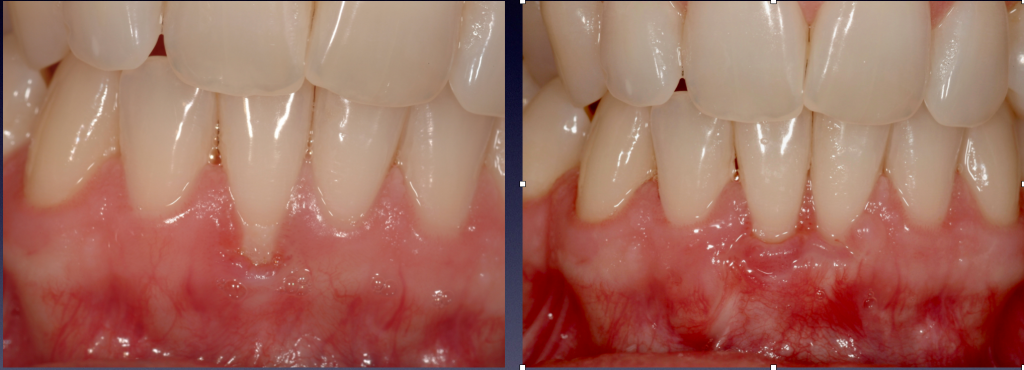 Before and After Photos: Gum Graft that covers exposed, sensitive tooth root