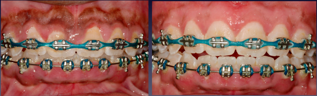 Before and After Photos: Gummy Smile Correction, with Braces