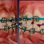 Before and After Photos: Gummy Smile Correction, with Braces