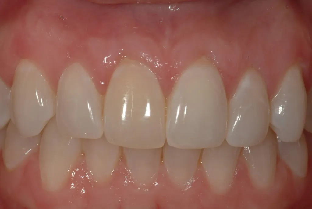 After Photo: Gingival recession covered around incisors case study in Bellmore NY