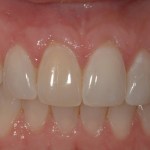 After Photo: Gingival recession covered around incisors case study in Bellmore NY