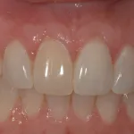 After Photo: Gingival recession covered around incisors case study in Bellmore NY