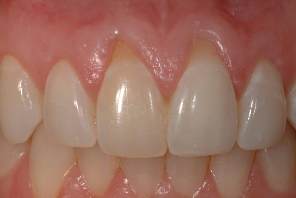 Before Photo: Gum recession around incisors case study in Bellmore NY