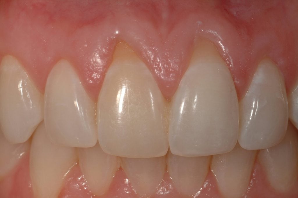 Before Photo: Gum recession around incisors case study in Bellmore NY