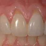 Before Photo: Gum recession around incisors case study in Bellmore NY