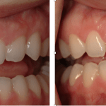 Patient's mouth after braces