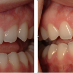 Patient's mouth after braces