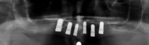 X-ray of an upper jaw with six dental implants
