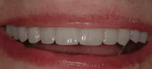 Patient's smile after placing dental implants