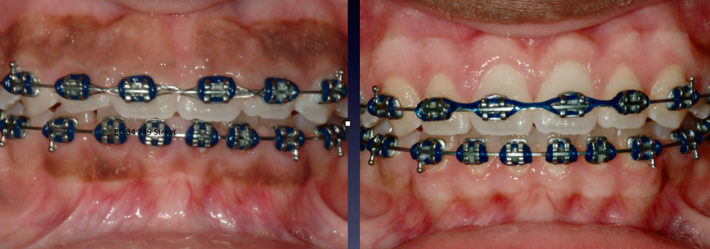 Patient's mouth with braces