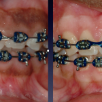 Patient's mouth with braces